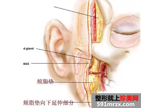 做脸部颊脂去除手术后脸会松弛吗？