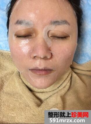 果酸换肤的效果4