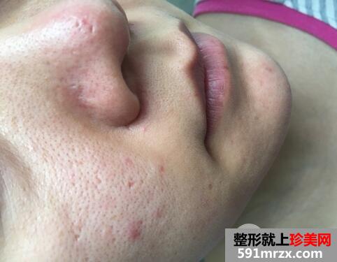 果酸换肤的效果6