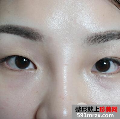 三点式双眼皮1