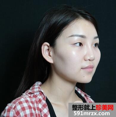 三点式双眼皮2