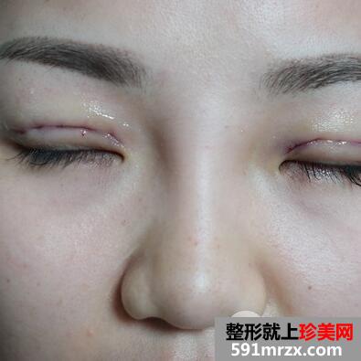 三点式双眼皮3