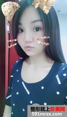 三点式双眼皮6