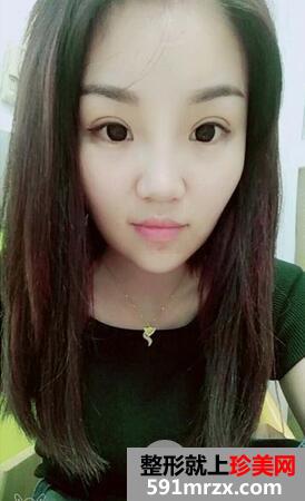三点式双眼皮7