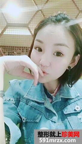 三点式双眼皮10