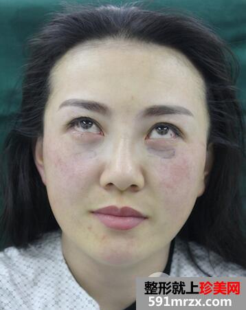 去眼袋安全吗3