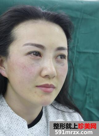 去眼袋安全吗4