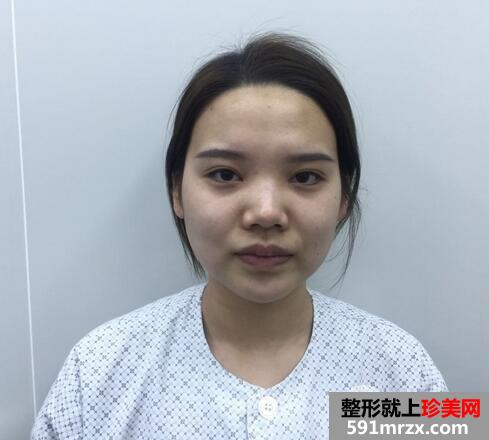 鼻头肥大缩小术1