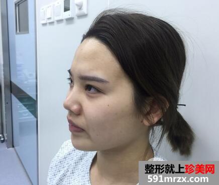 鼻头肥大缩小术2
