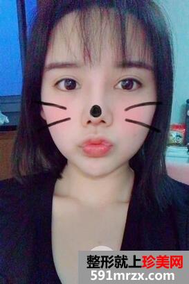 鼻头肥大缩小术7