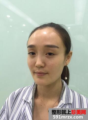 玻尿酸丰苹果肌1