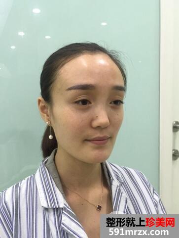 玻尿酸丰苹果肌2