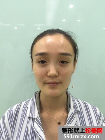 玻尿酸丰苹果肌3