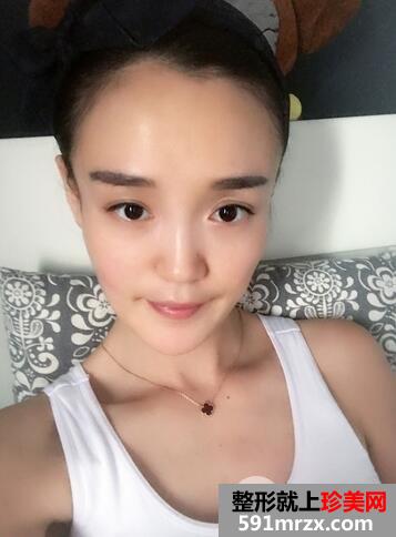 玻尿酸丰苹果肌5