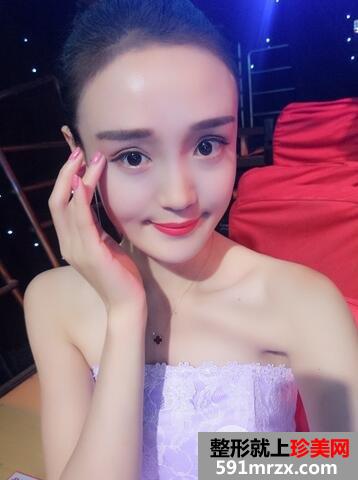 玻尿酸丰苹果肌13