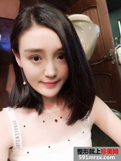 玻尿酸丰苹果肌14