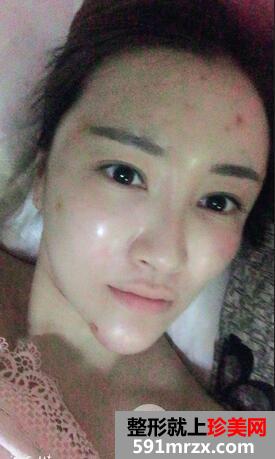 自体脂肪填充面部4
