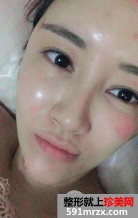 自体脂肪填充面部5