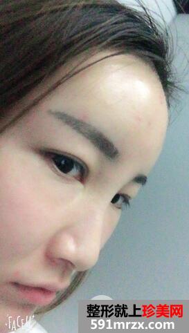 自体脂肪填充面部8