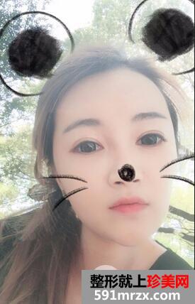 自体脂肪填充面部10