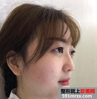 韩式双眼皮1