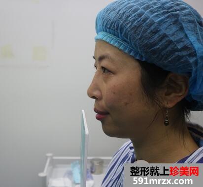 激光去眼袋1