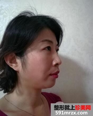 激光去眼袋6