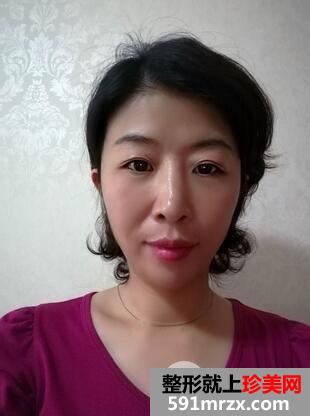 激光去眼袋7