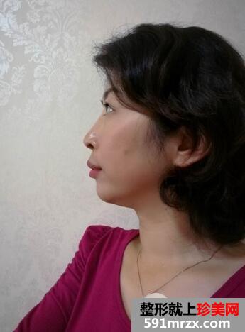 激光去眼袋8