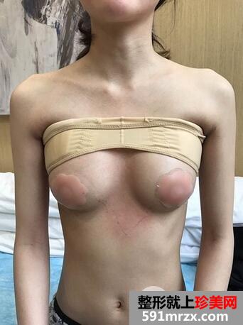 假体隆胸9