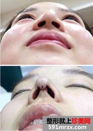鼻头肥大矫正2
