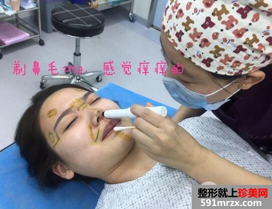 鼻头肥大矫正3