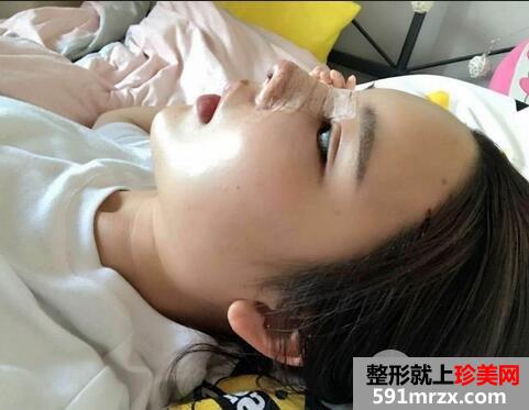 鼻头肥大矫正4