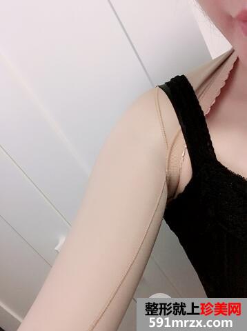 注射溶脂减肥6