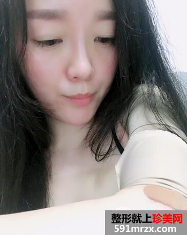 注射溶脂减肥8