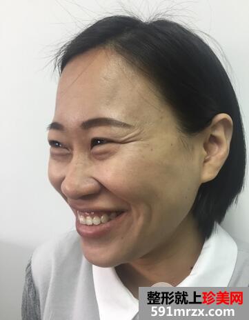 如何减少眼角皱纹1
