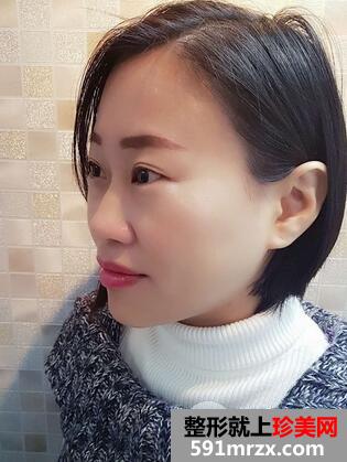 如何减少眼角皱纹4