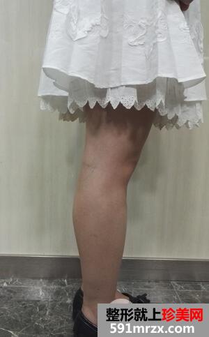 保妥适瘦小腿2