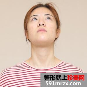 磨下颌角+双眼皮1