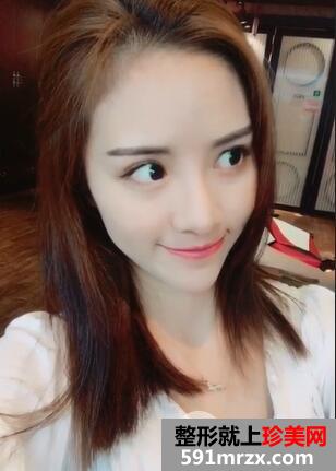磨下颌角+双眼皮6