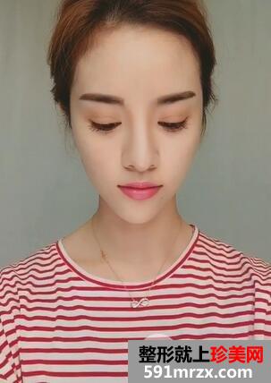 磨下颌角+双眼皮8