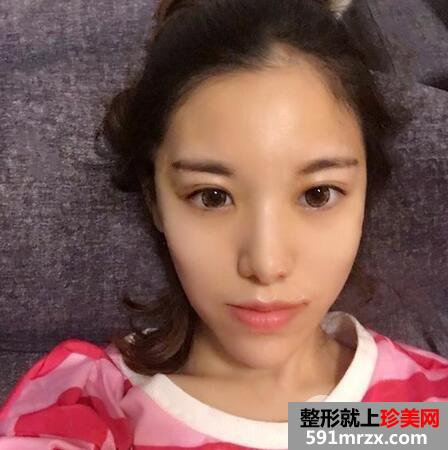 怎樣去鼻唇溝4