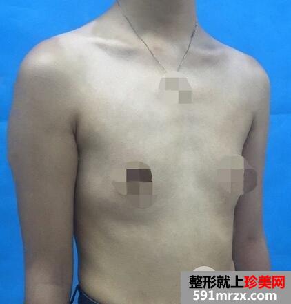琴面假体隆胸1