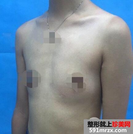 琴面假体隆胸2