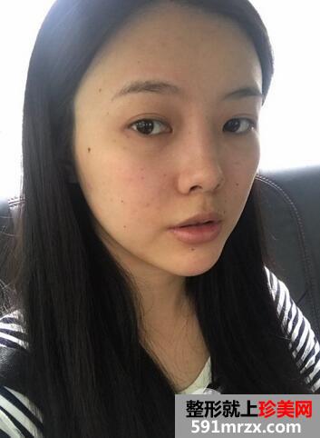 鼻综合1