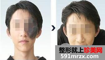 冷冻法去太田痣术后怎么保养？