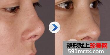 朝天鼻矫正方法有哪些？