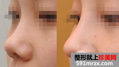 隆鼻之后鼻子为什么会发红？