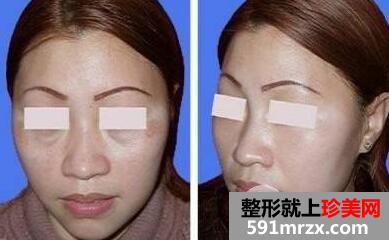 做完去眼袋手术多久恢复正常？