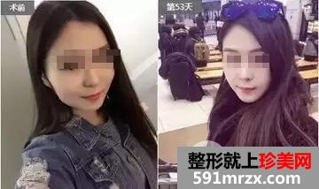 瘦脸针打几次定型